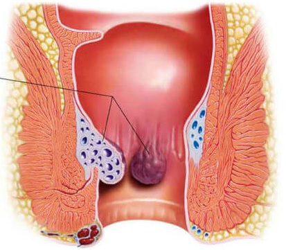 Jual Ambejoss Salep Salwa Obat Wasir De Nature Di Kolaka Utara
